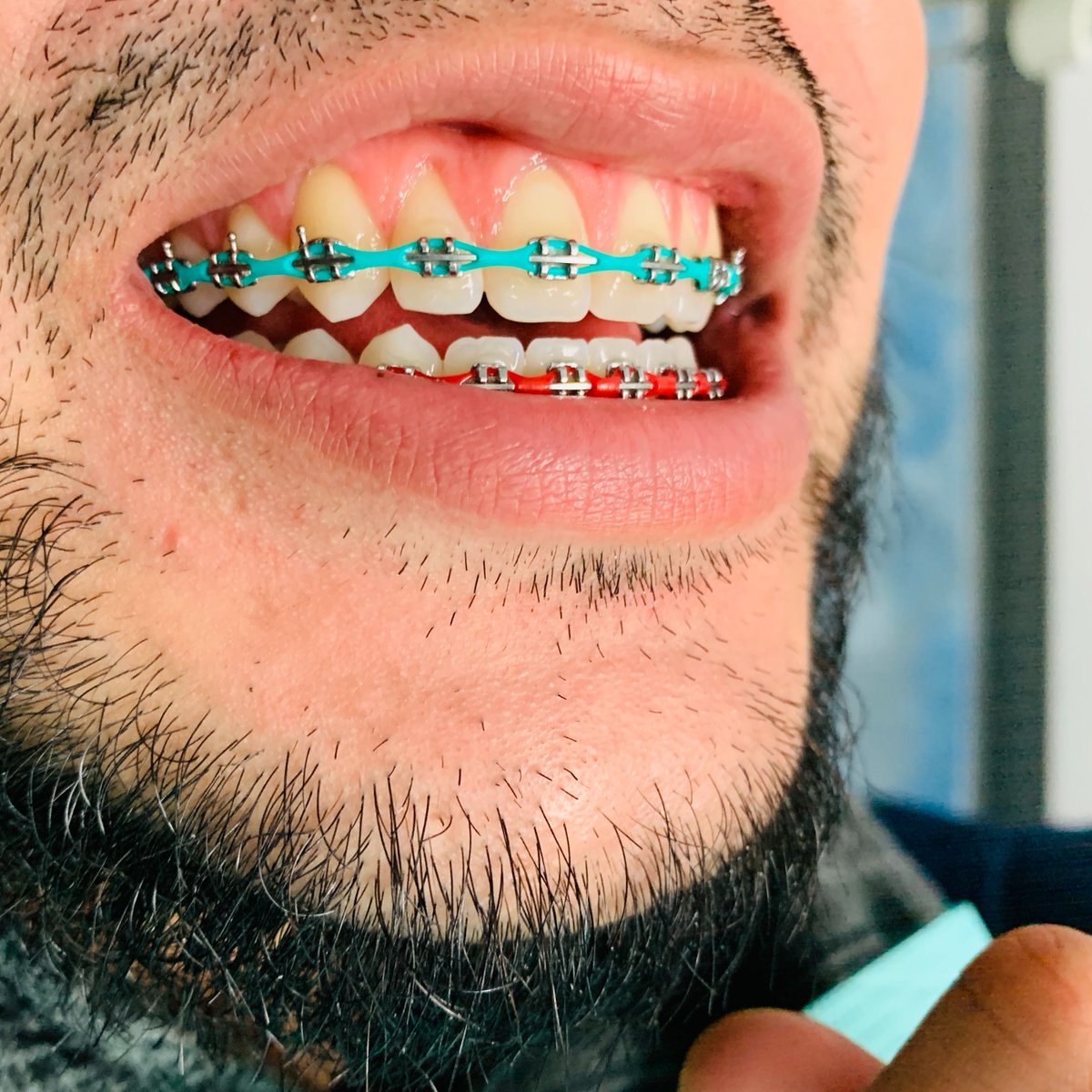 How to Choose The Best Braces Color For White Teeth?